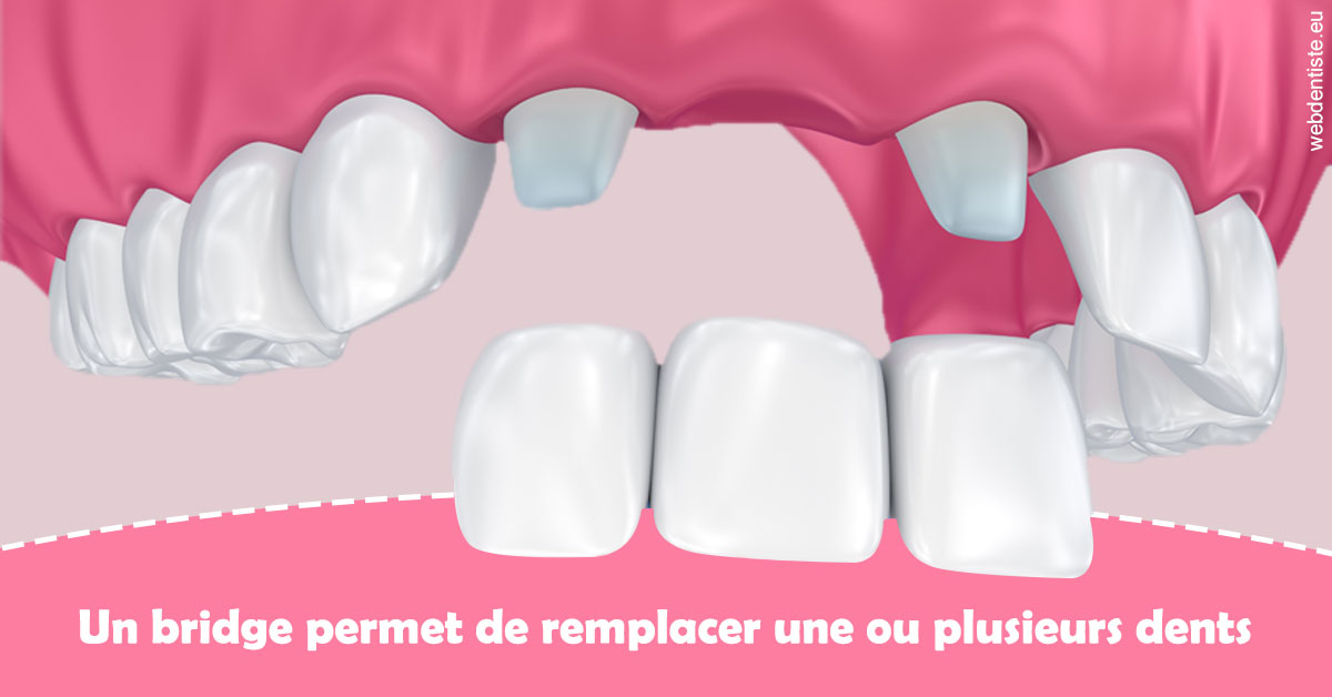 https://dr-marc-andre-benguigui.chirurgiens-dentistes.fr/Bridge remplacer dents 2