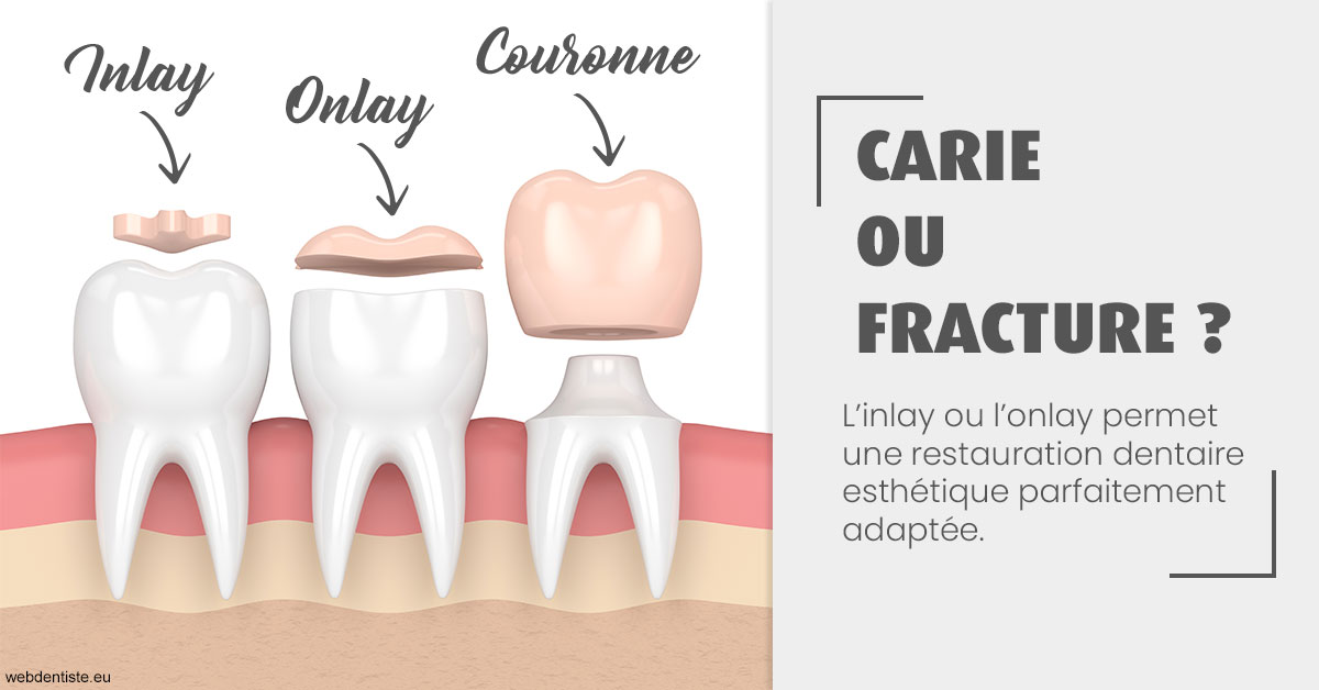 https://dr-marc-andre-benguigui.chirurgiens-dentistes.fr/T2 2023 - Carie ou fracture 1