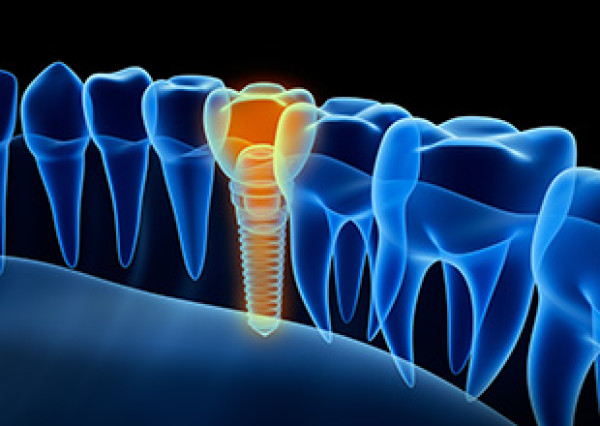 Pose de prothèse dentaire sur implant à Paris 16