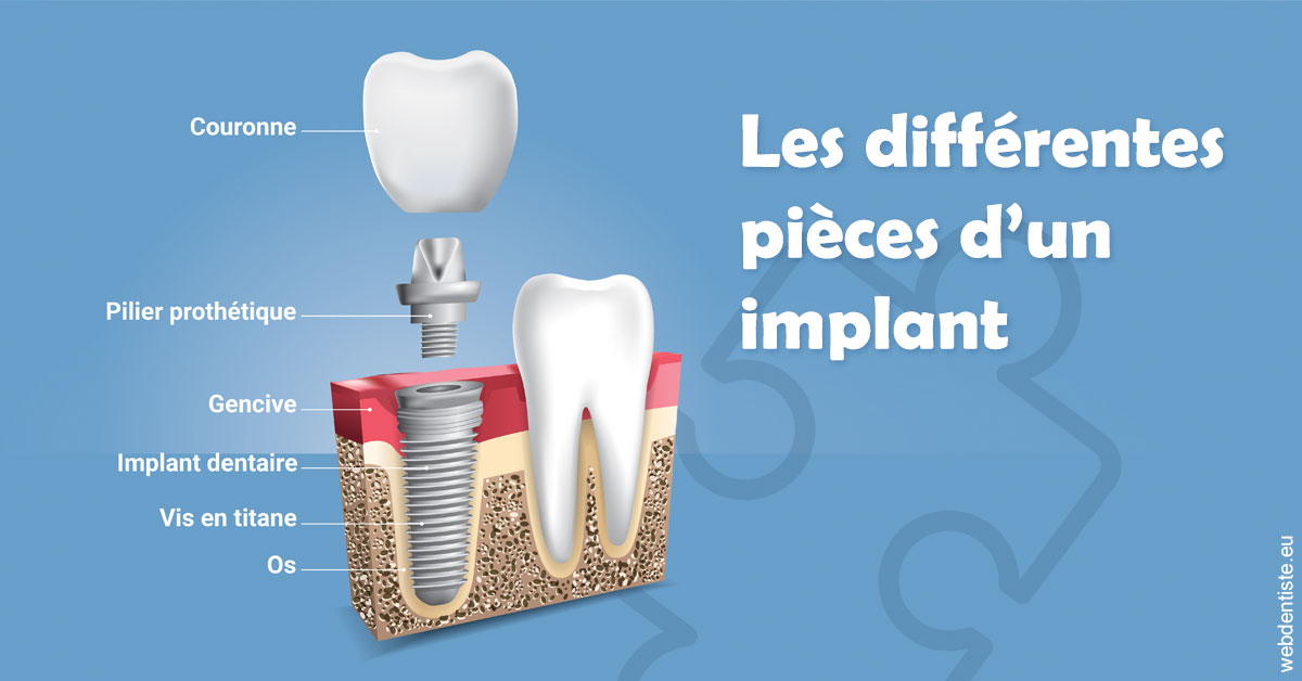 https://dr-marc-andre-benguigui.chirurgiens-dentistes.fr/Les différentes pièces d’un implant 1