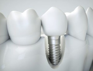Qu'est-ce qu'un implant dentaire ? Explication de votre dentiste à Paris 16